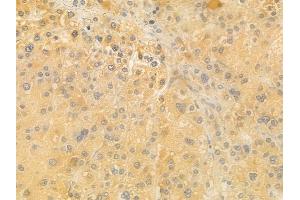 ABIN6266206 and ABIN6277362 at 1/100 staining human hepatocellular carcinoma by IHC-P.