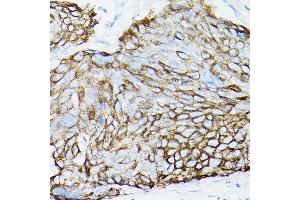 Immunohistochemistry of paraffin-embedded Human cervical squamous cell carcinoma using MUC1 Rabbit mAb (ABIN7268687) at dilution of 1:100 (40x lens). (MUC1 抗体)