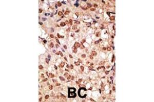 Formalin-fixed and paraffin-embedded human cancer tissue reacted with the primary antibody, which was peroxidase-conjugated to the secondary antibody, followed by DAB staining. (SIGLEC7 抗体  (N-Term))