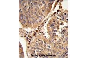 Formalin-fixed and paraffin-embedded human lung carcinoma reacted with PEX16 Antibody (Center), which was peroxidase-conjugated to the secondary antibody, followed by DAB staining. (PEX16 抗体  (AA 247-275))