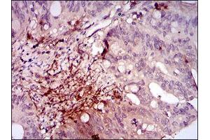 Immunohistochemical analysis of paraffin-embedded rectum cancer tissues using ILK mouse mAb with DAB staining.