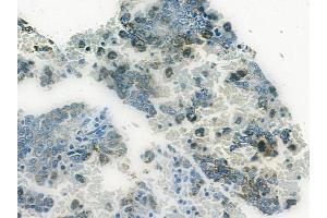 ABIN6265247 and ABIN6272432 at 1/100 staining human melanoma by IHC-P. (Sp3/4 抗体  (C-Term))