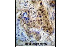 RPL3 Antibody (Center) (ABIN657323 and ABIN2846397) immunohistochemistry analysis in formalin fixed and paraffin embedded human breast carcinoma followed by peroxidase conjugation of the secondary antibody and DAB staining. (RPL3 抗体  (AA 224-251))