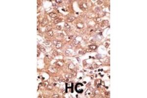 Formalin-fixed and paraffin-embedded human cancer tissue reacted with the primary antibody, which was peroxidase-conjugated to the secondary antibody, followed by DAB staining. (GDF2 抗体  (N-Term))