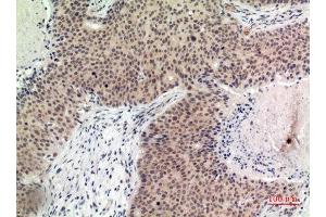 Immunohistochemistry (IHC) analysis of paraffin-embedded Human Breast Cancer, antibody was diluted at 1:100. (Histone H2B 抗体  (Internal Region))