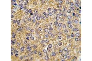 IHC analysis of FFPE human prostate carcinoma tissue stained with Urokinase antibody (PLAU 抗体  (AA 60-90))
