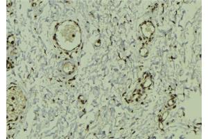 ABIN6272941 at 1/100 staining Human breast cancer tissue by IHC-P. (DEK 抗体  (Internal Region))