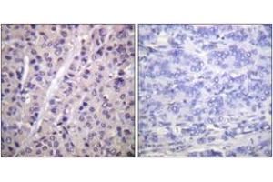 Immunohistochemistry analysis of paraffin-embedded human breast carcinoma, using A-RAF (Phospho-Tyr302) Antibody. (ARAF 抗体  (pTyr302))