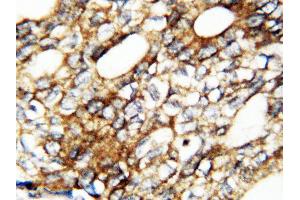 Anti-human FGF1 antibody, IHC(P) IHC(P): Human Mammary Cancer Tissue (FGF1 抗体  (AA 16-155))