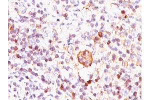 Formalin-fixed, paraffin-embedded Hodgkin's lymphoma stained with Bcl-x Mouse Monoclonal Antibody (BX006).