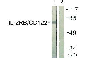 Immunohistochemistry analysis of paraffin-embedded human lung carcinoma tissue using IL-2Rβ/CD122 (Ab-364) antibody. (IL2 Receptor beta 抗体)