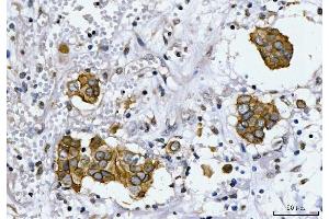 IHC analysis of HER2/ERBB2 using anti-HER2/ERBB2 antibody (ABIN7600737).