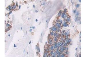 Detection of AGR2 in Human Colorectal cancer Tissue using Monoclonal Antibody to Anterior Gradient 2 (AGR2) (AGR2 抗体  (AA 21-175))