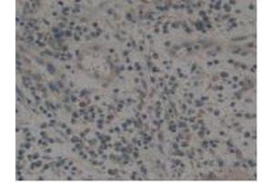 IHC-P analysis of Human Skin Cancer Tissue, with DAB staining. (Tissue factor 抗体  (AA 34-251))