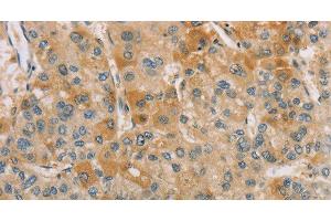 Immunohistochemistry of paraffin-embedded Human liver cancer tissue using CENPF Polyclonal Antibody at dilution 1:40 (CENPF 抗体)