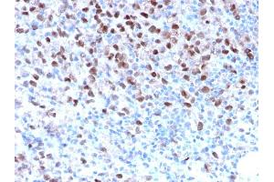 Formalin-fixed, paraffin-embedded human Melanoma stained with MITF Recombinant Rabbit Monoclonal Antibody (MITF/2987R). (Recombinant MITF 抗体)