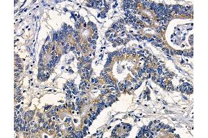 ABIN7095031 and ABIN7099087 at 1/100 staining human colorectal cancer by IHC-P.