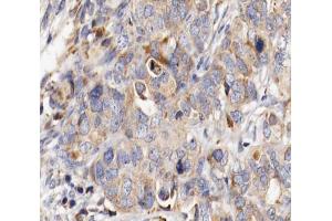 ABIN6266804 at 1/100 staining human ovarian cancer tissue sections by IHC-P. (MUC13 抗体  (C-Term))