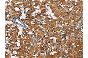 The image on the left is immunohistochemistry of paraffin-embedded Human thyroid cancer tissue using ABIN7130004(KLF7 Antibody) at dilution 1/60, on the right is treated with fusion protein. (KLF7 抗体)