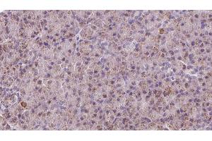 ABIN6273219 at 1/100 staining Human pancreas cancer tissue by IHC-P. (CTNNA3 抗体  (Internal Region))