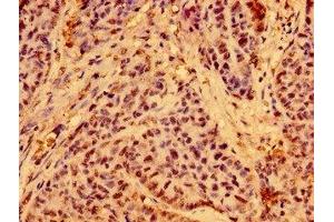 Immunohistochemistry of paraffin-embedded human ovarian cancer using ABIN7165166 at dilution of 1:100