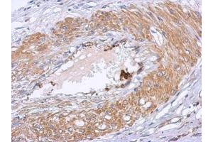 IHC-P Image Immunohistochemical analysis of paraffin-embedded human gastric cancer, using Dystrobrevin beta, antibody at 1:500 dilution. (Dystrobrevin beta 抗体)