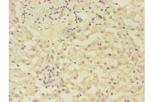 Immunohistochemistry of paraffin-embedded human liver cancer using ABIN7153293 at dilution of 1:100 (GRK4 抗体  (AA 1-245))