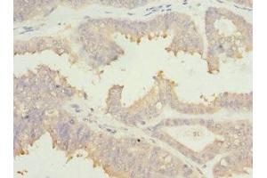 Immunohistochemistry of paraffin-embedded human prostate cancer using ABIN7172902 at dilution of 1:100 (EIF2B1 抗体  (AA 1-305))