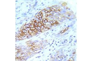 Immunohistochemical analysis of paraffin- embedded human lung adenocarcinoma tissue using FGFR1 (Ab-154) Antibody (E022077). (FGFR1 抗体)