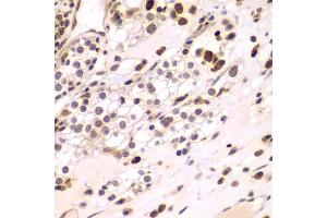 Immunohistochemistry of paraffin-embedded human kidney cancer using CEBPG antibody (ABIN5974381) at dilution of 1/100 (40x lens). (CEBPG 抗体)