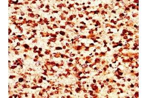 IHC image of nforHU diluted at 1:50 and staining in paraffin-embedded human glioma performed on a Leica BondTM system. (HIST1H1C 抗体)