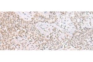 Immunohistochemistry of paraffin-embedded Human ovarian cancer tissue using SMNDC1 Polyclonal Antibody at dilution of 1:50(x200) (SMNDC1 抗体)