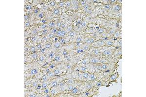 Immunohistochemistry of paraffin-embedded human liver injury using SLC2A2 antibody (ABIN6003575) at dilution of 1/100 (40x lens). (SLC2A2 抗体)