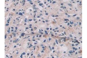 Detection of IL12A in Human Prostate cancer Tissue using Monoclonal Antibody to Interleukin 12A (IL12A) (IL12A 抗体  (AA 23-219))