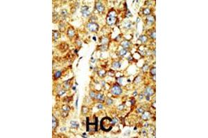Formalin-fixed and paraffin-embedded human hepatocellular carcinoma tissue reacted with the SETD8 polyclonal antibody  , which was peroxidase-conjugated to the secondary antibody, followed by DAB staining. (SETD8 抗体  (AA 25-53))