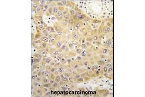 Formalin-fixed and paraffin-embedded human hepatocarcinoma tissue reacted with GRK5 Antibody (C-term) (ABIN390988 and ABIN2841171) , which was peroxidase-conjugated to the secondary antibody, followed by DAB staining. (GRK5 抗体  (C-Term))