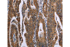 Immunohistochemistry of Human gastric cancer using FAF1 Polyclonal Antibody at dilution of 1:50 (FAF1 抗体)