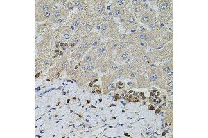 Immunohistochemistry of paraffin-embedded human liver injury using S100A12 antibody. (S100A12 抗体  (AA 1-92))