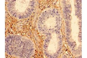 Immunohistochemistry of paraffin-embedded human colon cancer using ABIN7173954 at dilution of 1:100 (INPP5A 抗体  (AA 1-409))
