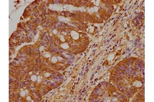 IHC image of ABIN7164121 diluted at 1:400 and staining in paraffin-embedded human colon cancer performed on a Leica BondTM system. (PRAMEF18 抗体  (AA 1-257))