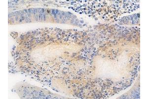 ABIN6264879 and ABIN6272562 at 1/100 staining human colon carcinoma by IHC-P.