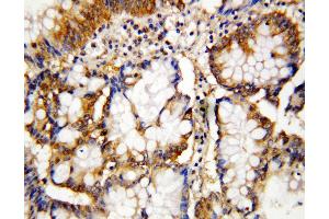 Anti-Caspase-10 antibody, IHC(P) IHC(P): Human Intestinal Cancer Tissue (Caspase 10 抗体  (N-Term))