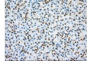 Immunohistochemical staining of paraffin-embedded Adenocarcinoma of Human colon tissue using anti-PDE4A mouse monoclonal antibody. (PDE4A 抗体)