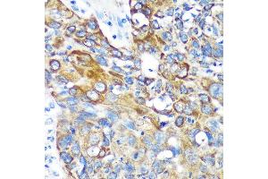 Immunohistochemistry of paraffin-embedded Human lung cancer using KIF17 Rabbit pAb (ABIN7268123) at dilution of 1:100 (40x lens). (KIF17 抗体  (AA 360-660))