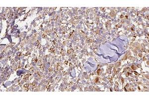 ABIN6276844 at 1/100 staining Human Melanoma tissue by IHC-P. (SCGB1A1 抗体  (Internal Region))