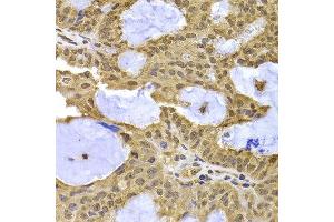 Immunohistochemistry of paraffin-embedded human oophoroma using XPO5 antibody at dilution of 1:100 (x400 lens). (XPO5 抗体)