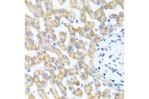 Immunohistochemistry of paraffin-embedded human liver injury using RIPK4 antibody. (RIPK4 抗体  (AA 240-520))