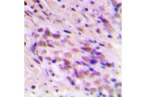 Immunohistochemical analysis of CDYL2 staining in human breast cancer formalin fixed paraffin embedded tissue section. (CDYL2 抗体  (N-Term))