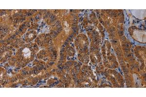 Immunohistochemistry of paraffin-embedded Human thyroid cancer tissue using MAGEB10 Polyclonal Antibody at dilution 1:60 (MAGEB10 抗体)