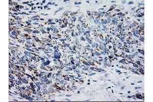 Immunohistochemical staining of paraffin-embedded Adenocarcinoma of Human colon tissue using anti-XPNPEP3 mouse monoclonal antibody. (XPNPEP3 抗体)